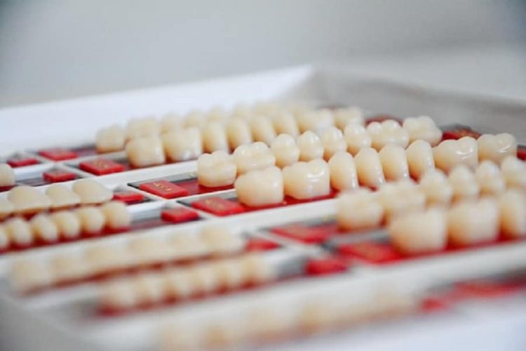 Fatete dentare pentru corectarea inestetica a dintilor frontali