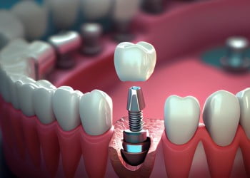 sunt calificat pentru o intervenție de implant dentar complet?